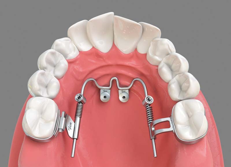 Orthodontic Appliances